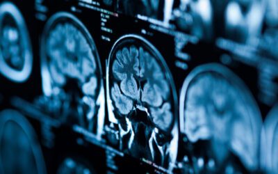 Ipilimumab: First Patient Free of Glioblastoma After Receiving Neoadjuvant Immunotherapy